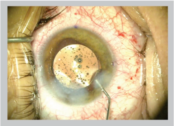 Perioperative medications can eliminate postoperative drops after cataract surgery