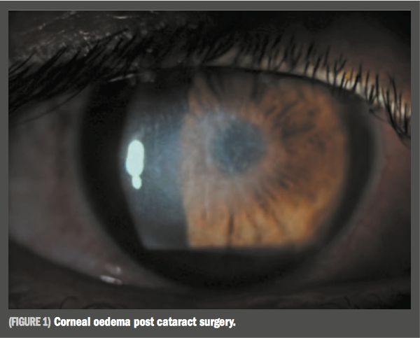 swelling in retina after cataract surgery)