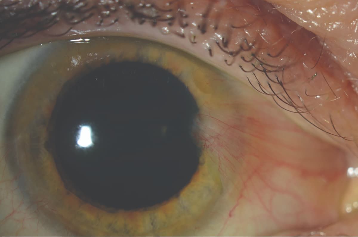 Figure. A patient’s eye with pterygium extending onto the cornea. (Image courtesy of Beeran B. Meghpara, MD) Figure. A patient’s eye with pterygium extending onto the cornea. (Image courtesy of Beeran B. Meghpara, MD)
