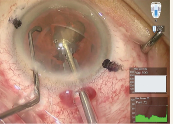 Seven pearls for a more stable chamber