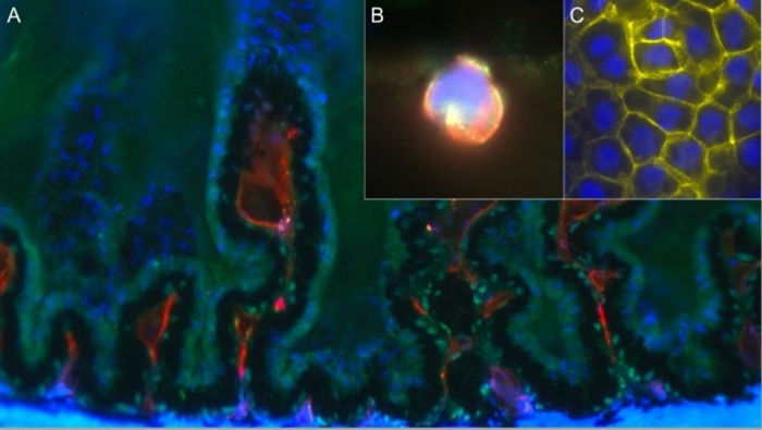 Immune cell trafficking in diabetic cataract formation. (A) Novel in situ visualization technique for studies of immune cell trafficking in the eye. (B) Immune cell passing through ciliary body’s epithelial cells. (C) Microstructural lesions in the early phases of diabetic cataract formation. (Image provided by Hafezi-Moghadam et al)