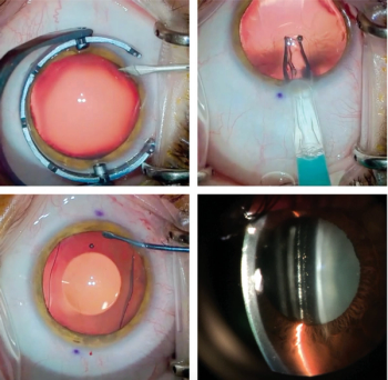 Investigators examine anti-VEGF medications in cases with ROP