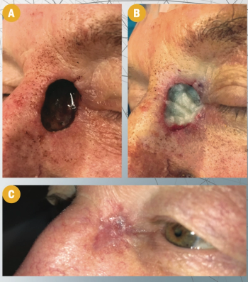 Reconstructing the eyelid