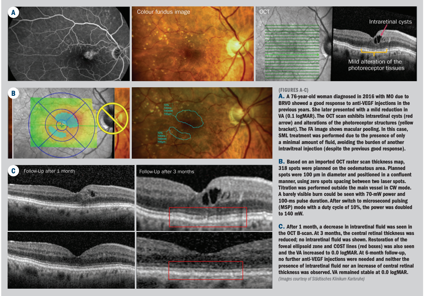 Micropulse laser therapy a safe treatment for retinal disorders