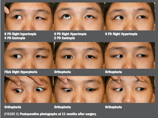 Anteronasal Transposition A New Twist On The Inferior Oblique Muscle