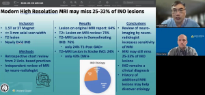 NeuroOp Guru: High-resolution MRI may miss a third of INO lesions