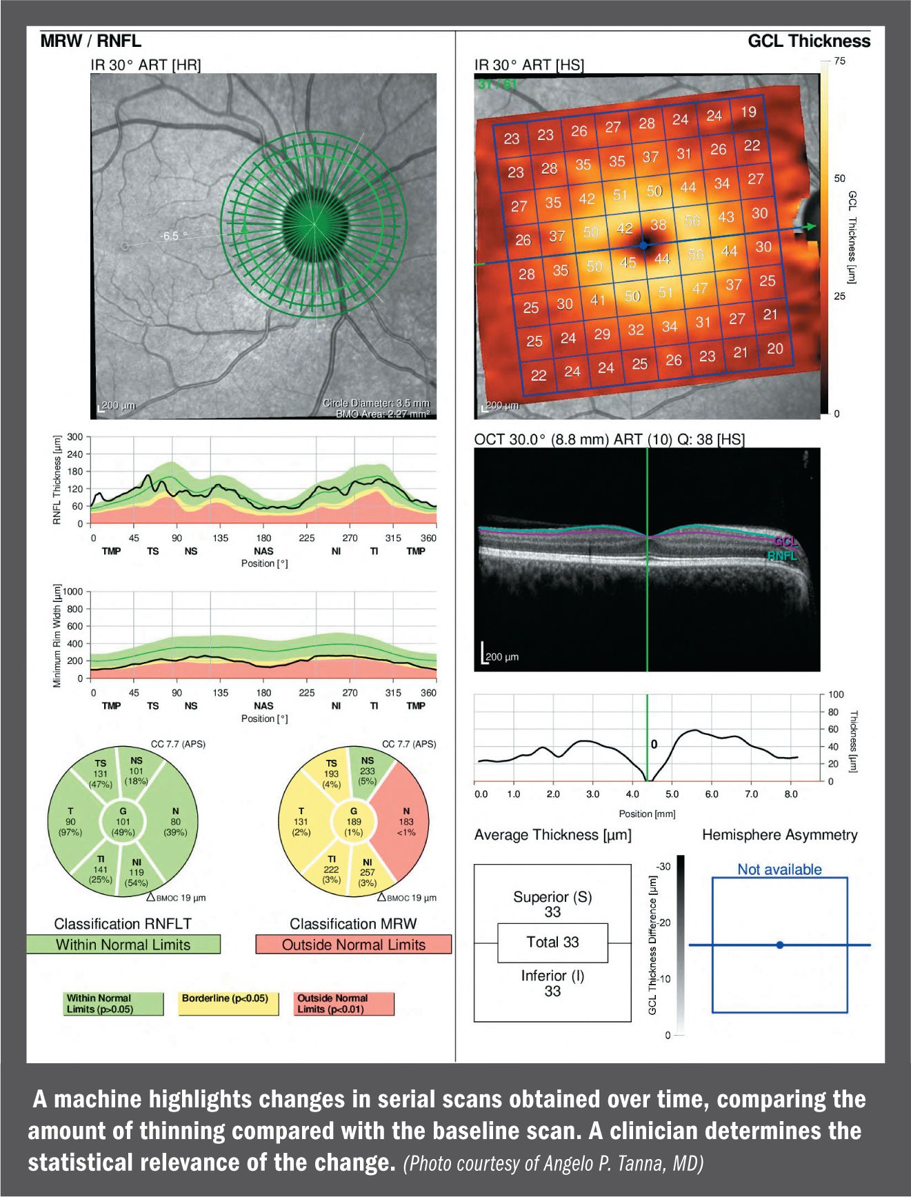 Technology assisting surgeons in capturing spectral-domain OCT
