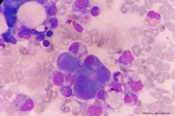 melanoma