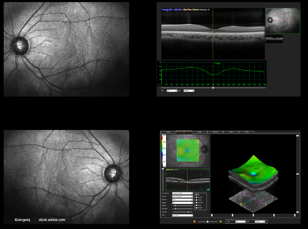 Large fluctuations in central subfield thickness in DME: predictor of worse VA?