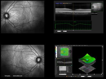 Large fluctuations in central subfield thickness in DME: predictor of worse VA?