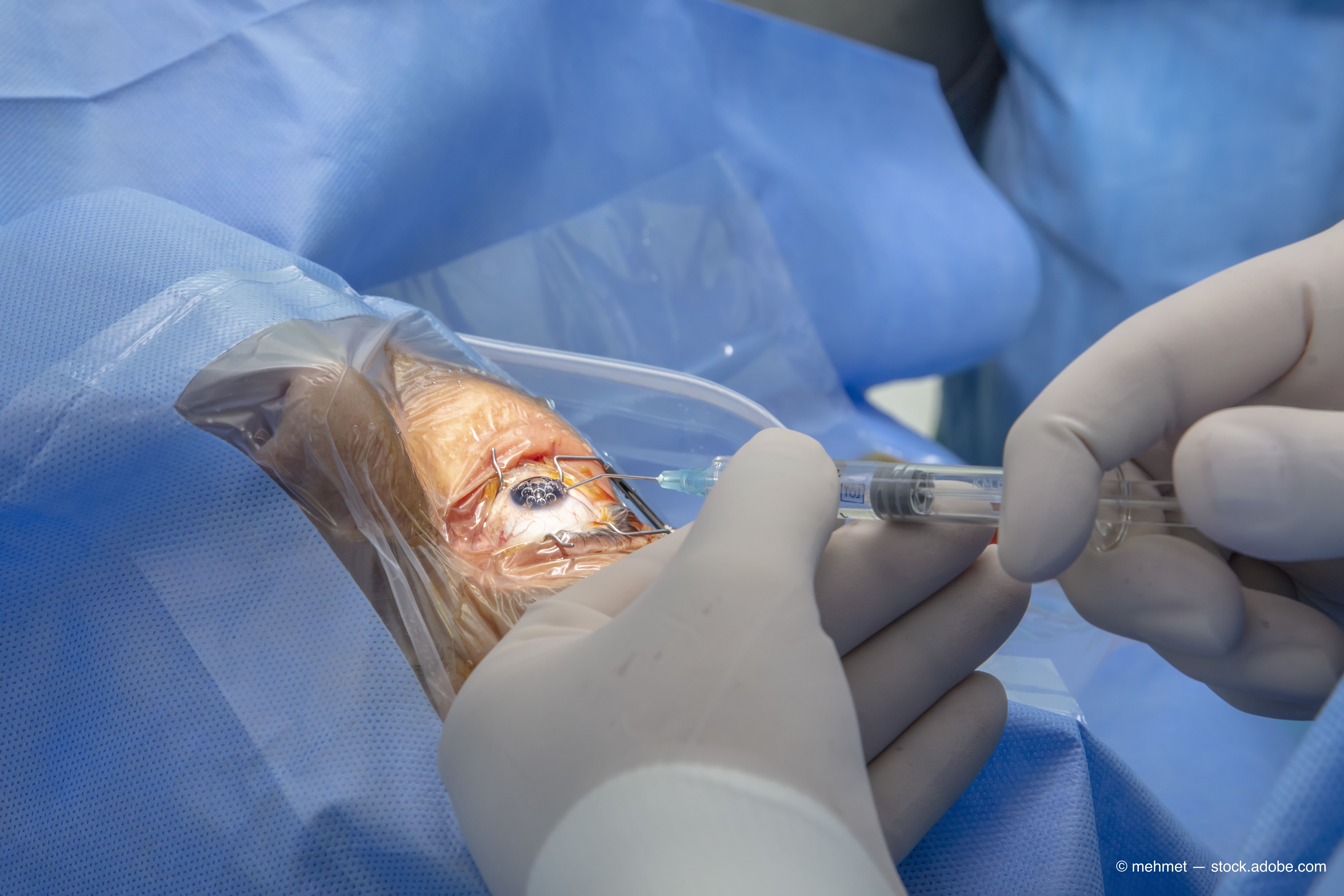 Anti-VEGF injections