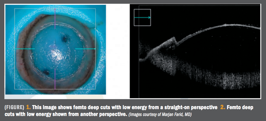 Bringing DALK application to forefront for corneal surgeons