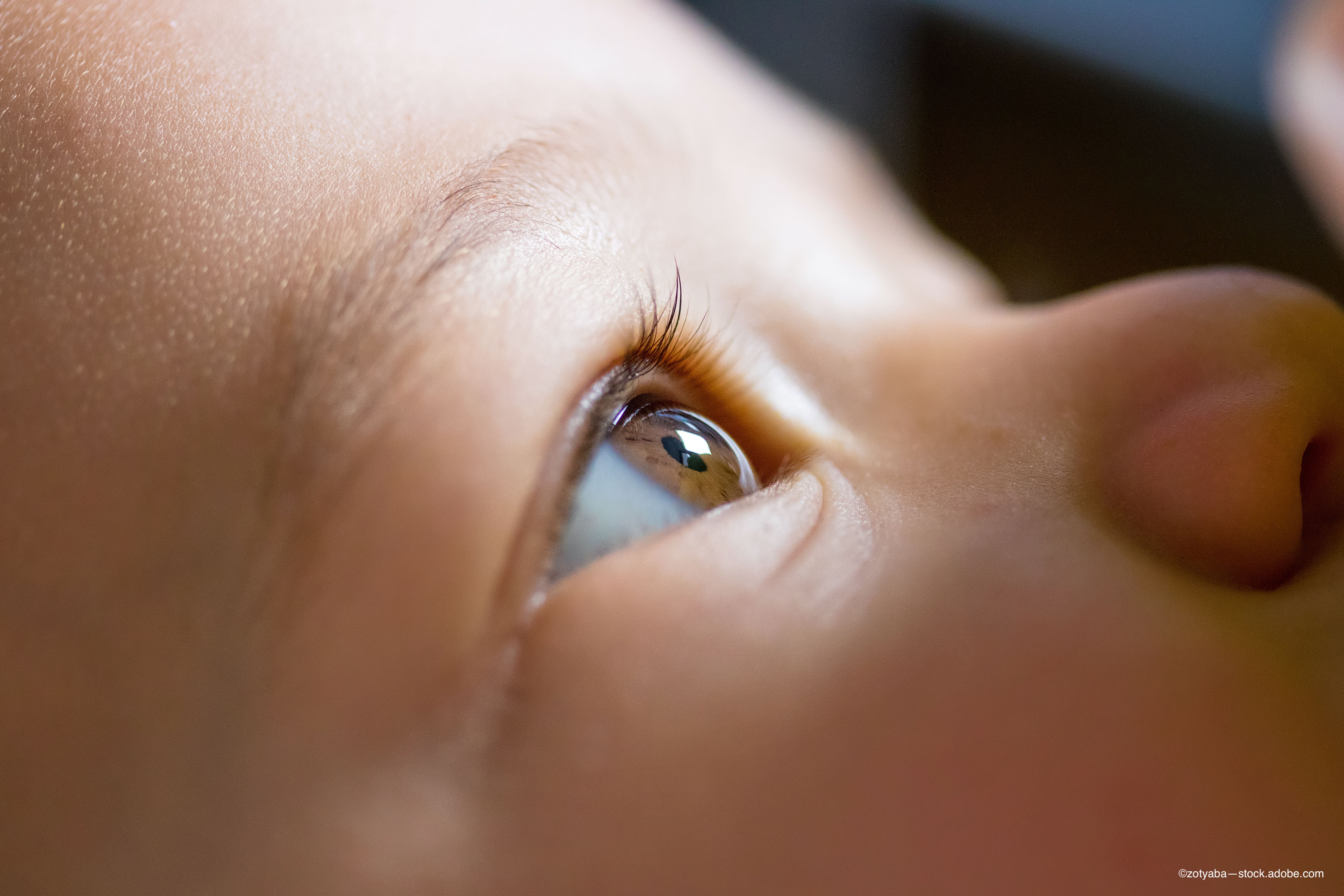 Study reports that optic nerve pallor is prevalent in ZIKA virus patients