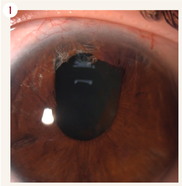 Figure 1. A patient's eye after explantation the second year after follow-up.