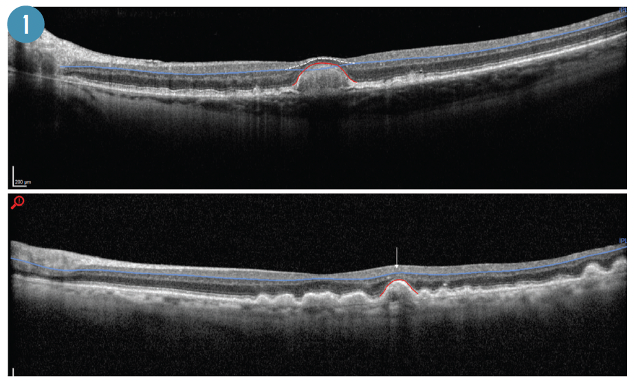 Examples of the effect of large Drusen on inner retinal layers. Top, an OCT scan of large drusen