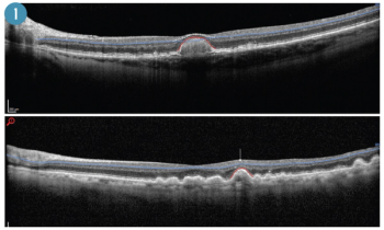 Effect of drusen and atrophy on automated segmentation in OCT images 