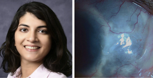 Pearls for management of Pseudomonas scleritis