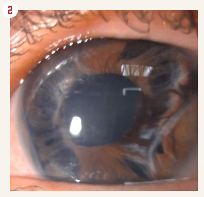 Figura 2. El ojo después de la explantación 4 años después del seguimiento.