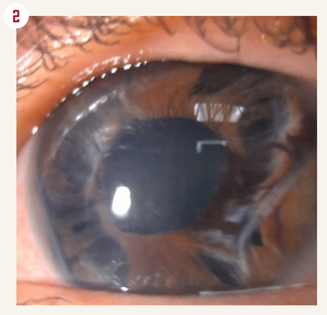 Figure 2. The eye following explantation 4 years after follow-up.