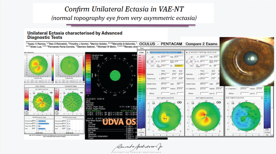 The Pathophysiology And Pathomorphology Of Corneal Ectasia: Multimodal ...