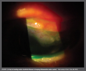 keep inflammation under control to treat ocular cicatricial disease