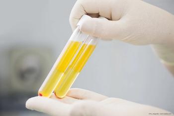 Plasma metabolomic profiles could predict AMD progression