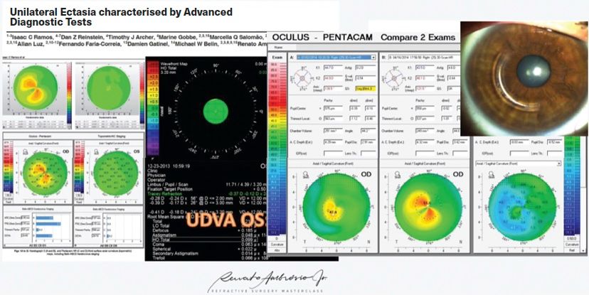The pathophysiology and pathomorphology of corneal ectasia: Multimodal imaging techniques yield vital screening and diagnostics data