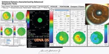 The pathophysiology and pathomorphology of corneal ectasia: Multimodal imaging techniques yield vital screening and diagnostics data