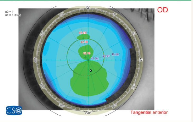 Figure 1. A case of keratoconus with normal topography.