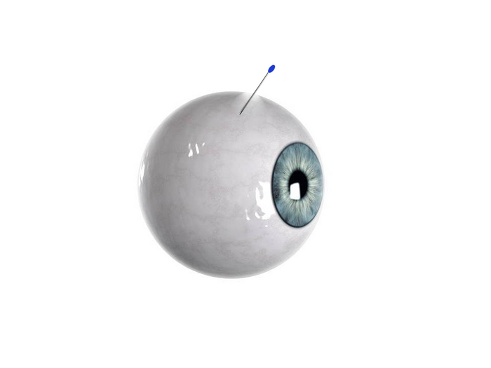 Self-plugging microneedles may improve drug delivery in the eye