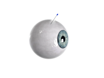 Self-plugging microneedles may improve drug delivery in the eye
