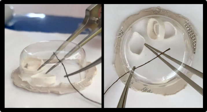 Figure 5C. Using forceps and a suture, thread the hoops onto the thread. Repeat as required with both dominant and non-dominant hands.