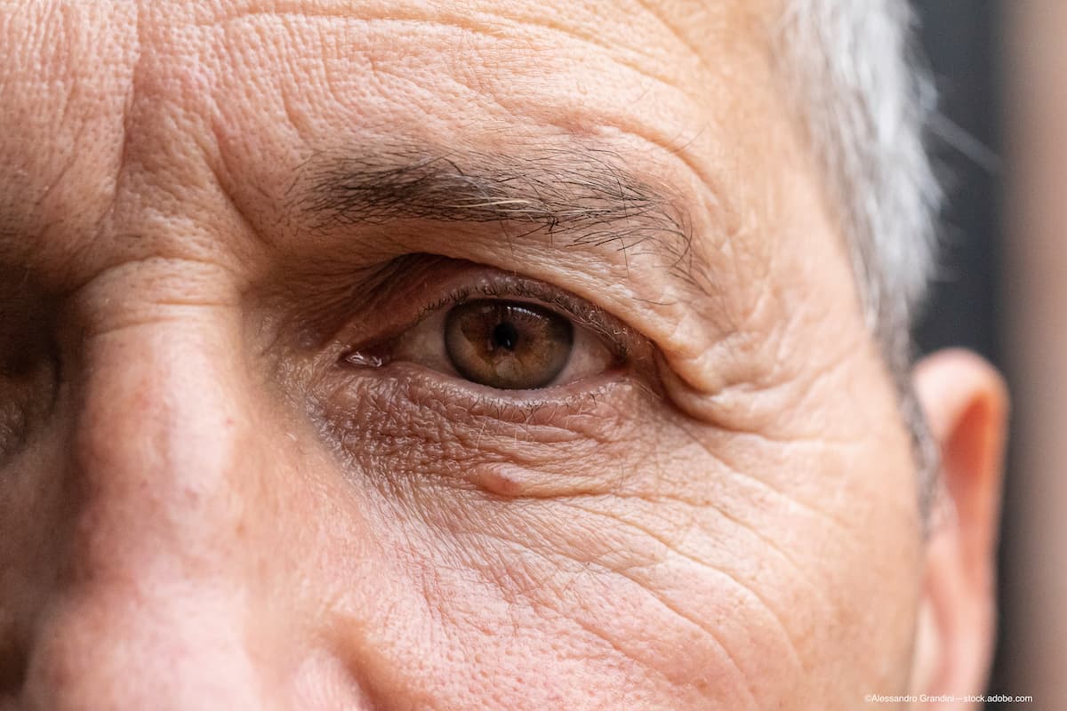 Less is more with redesigned probe for MicroPulse TLT for glaucoma