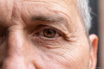 Less is more with redesigned probe for MicroPulse TLT for glaucoma