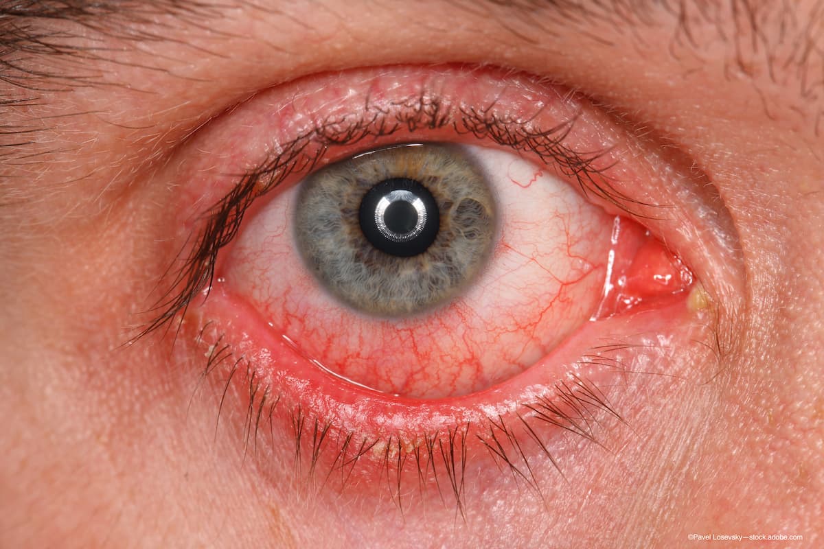 Monkeypox may be linked with conjunctivitis