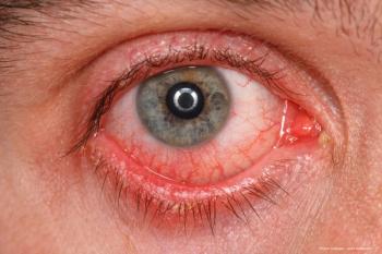 Monkeypox may be linked with conjunctivitis
