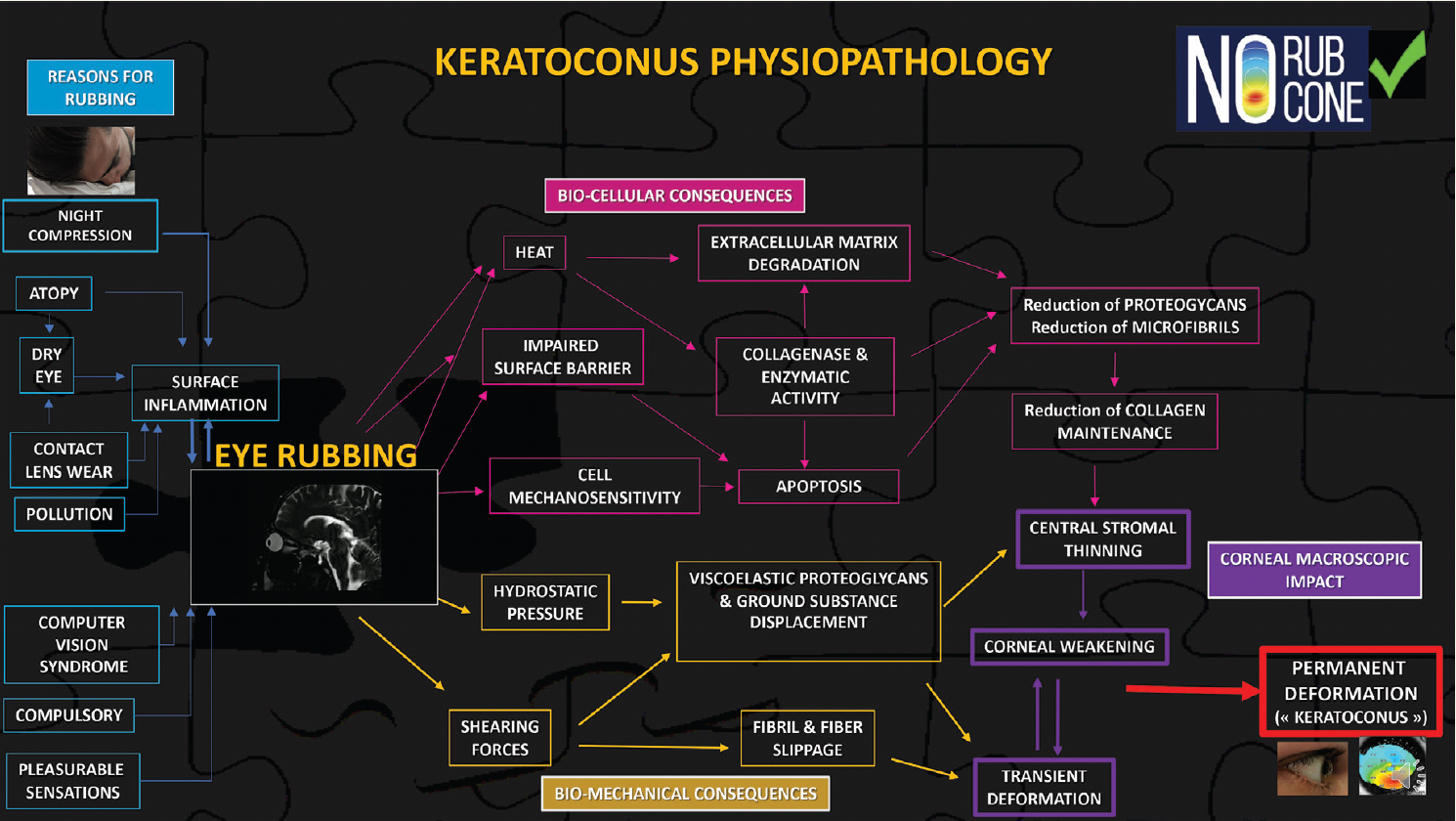 The Pathophysiology And Pathomorphology Of Corneal Ectasia: Keratoconus ...