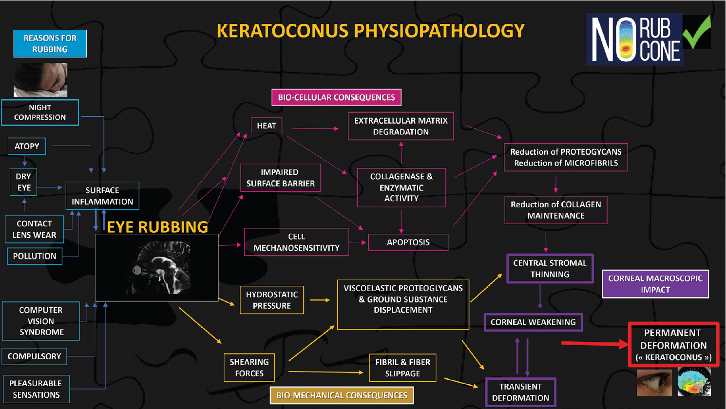 Figure 5. Proposed route for keratoconus physiopathology. (All images courtesy of Prof. Damien Gatinel)