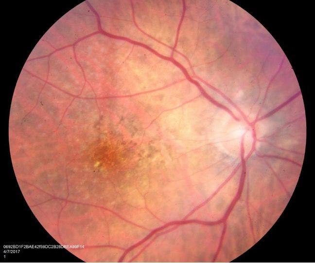 Figure 1. Fundus photography shows macular drusen and retinal pigment epithelium changes. No evidence of subretinal haemorrhage was observed. 