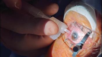 New IOL offers patients greater spectacle independence over wider range