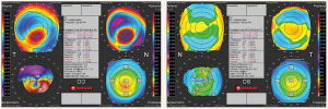 The pathophysiology and pathomorphology of corneal ectasia: Keratoconus will not develop without eye rubbing