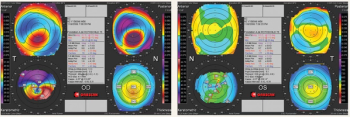 The pathophysiology and pathomorphology of corneal ectasia: Keratoconus will not develop without eye rubbing