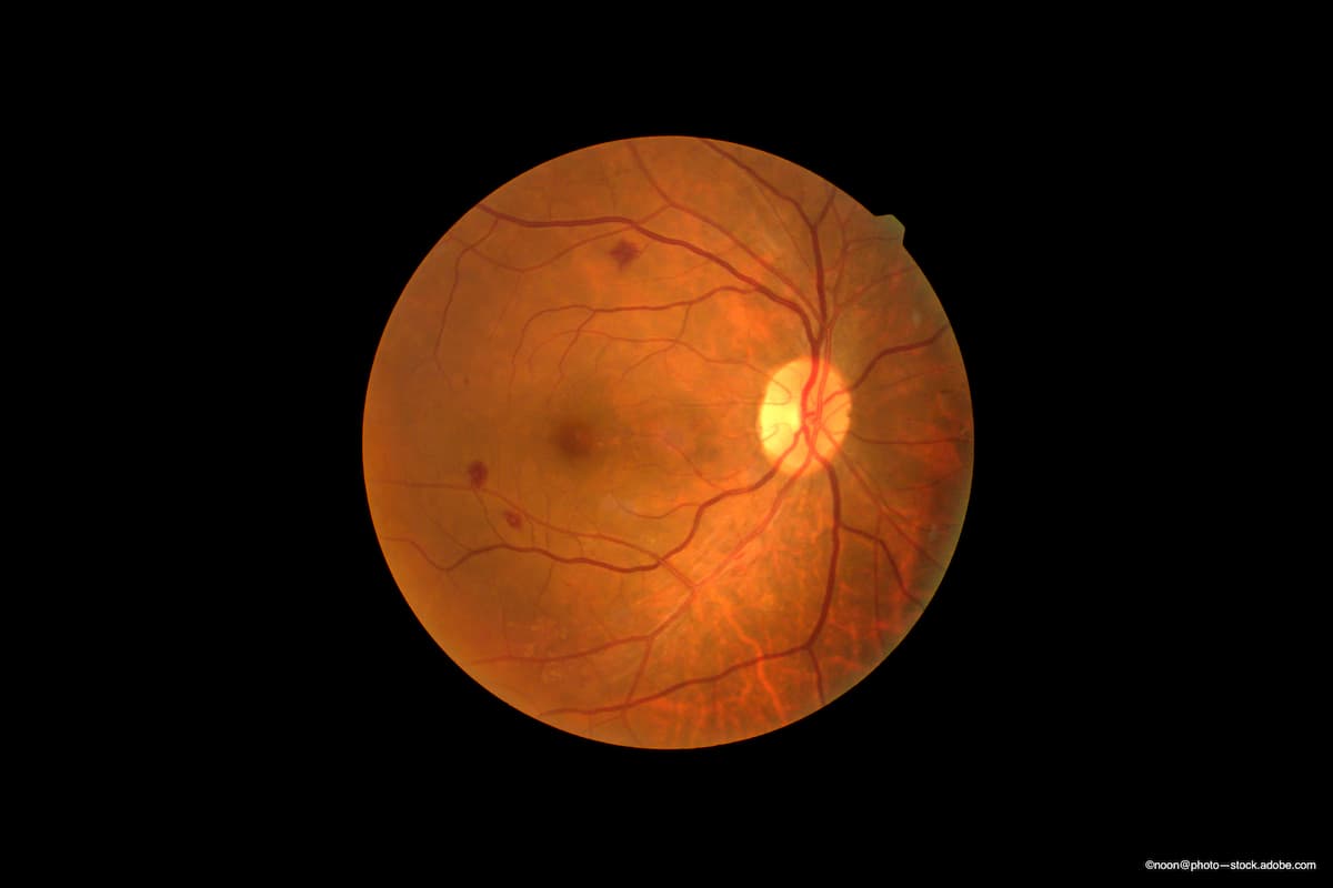 DMO treatment: Brolucizumab proves noninferior to aflibercept, requires fewer injections