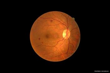 DMO treatment: Brolucizumab proves noninferior to aflibercept, requires fewer injections