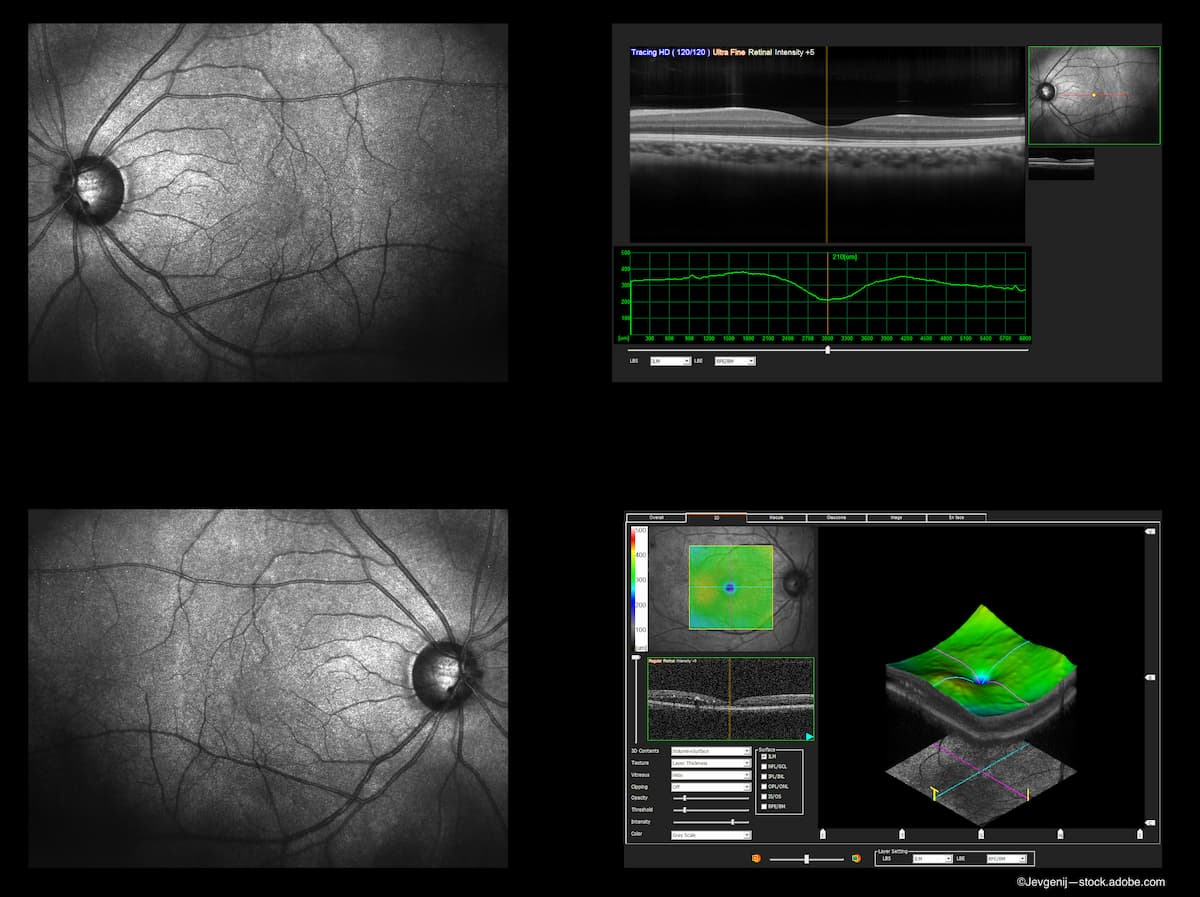Central subfield thickness fluctuations in DMO may predict worse VA