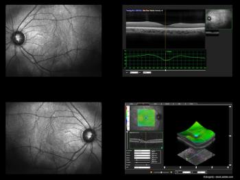 Central subfield thickness fluctuations in DMO may predict worse VA