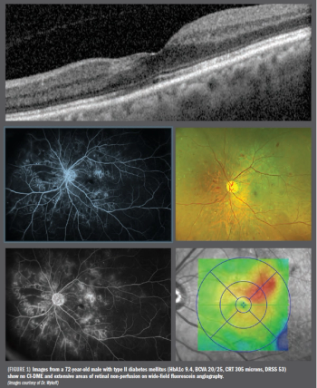 Type II diabetes mellitus