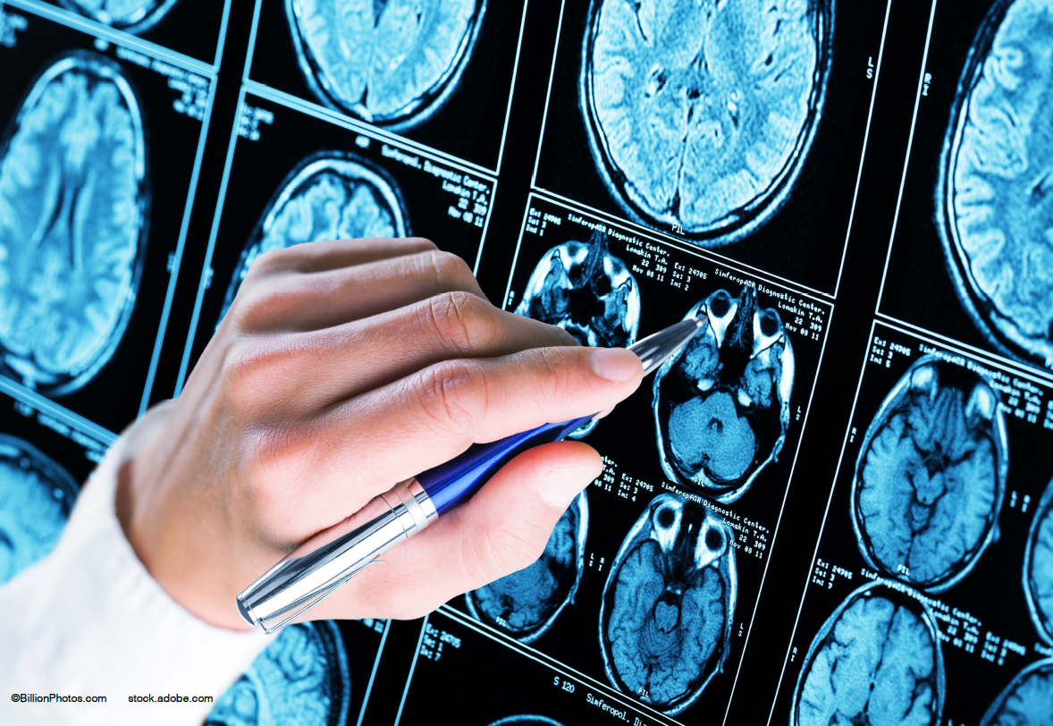 cataract removal lowers dementia risk