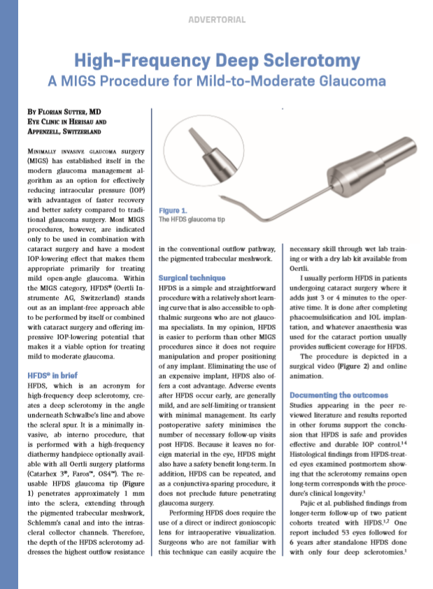 High-Frequency Deep SclerotomyA MIGS Procedure for Mild-to-Moderate Glaucoma