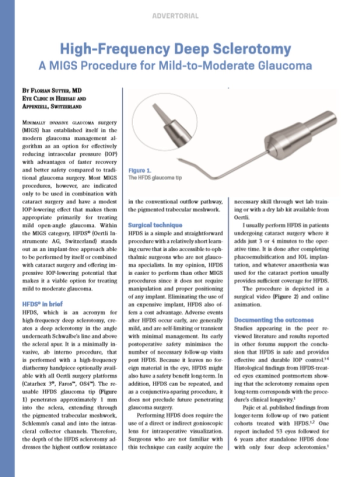 High-Frequency Deep SclerotomyA MIGS Procedure for Mild-to-Moderate Glaucoma